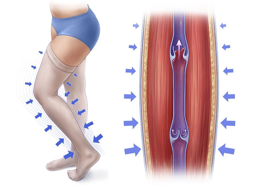 What is Compression Therapy