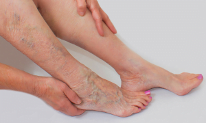 Varicose Vein