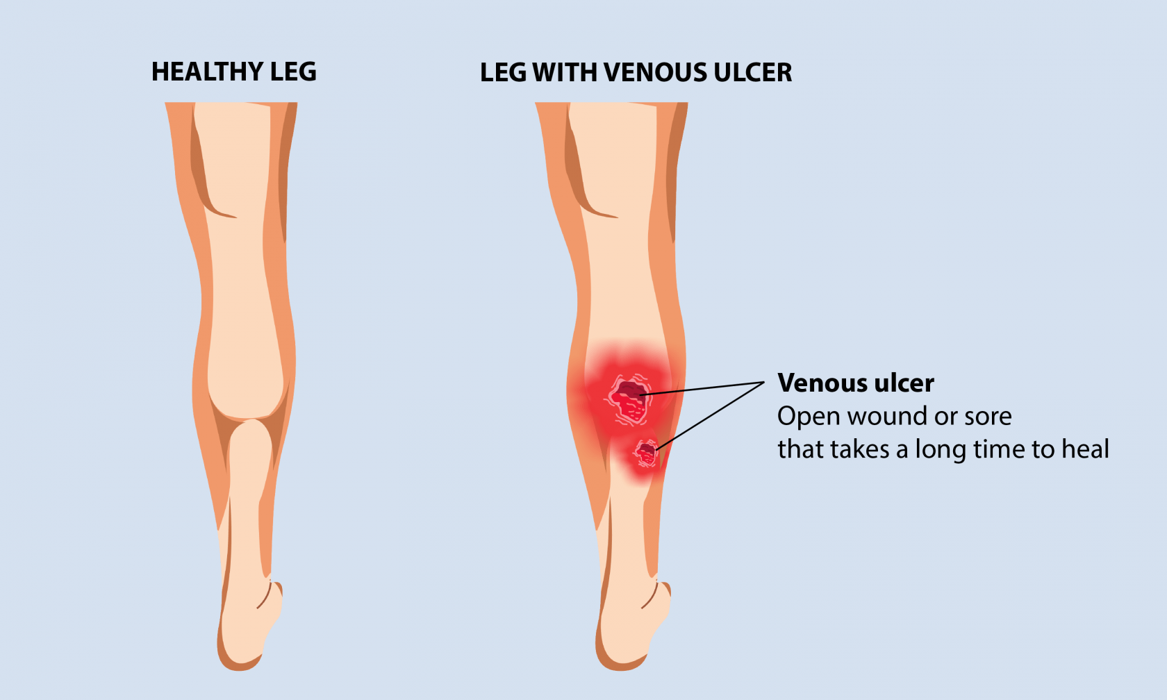 Venous Leg Ulcer: Symptoms, Causes, and Prevention