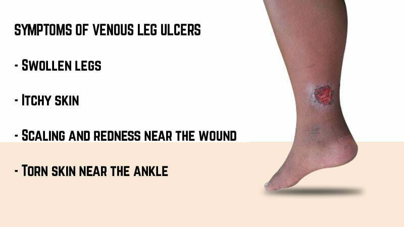 symptoms-venous-leg-ulcer