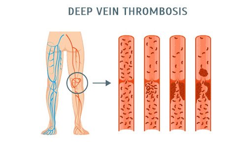 Deep vein thrombosis treatment