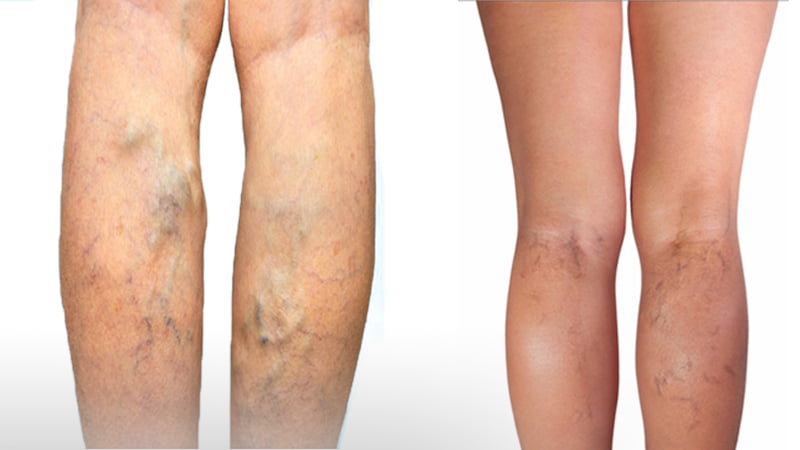 Spider Veins VS Varicose Veins