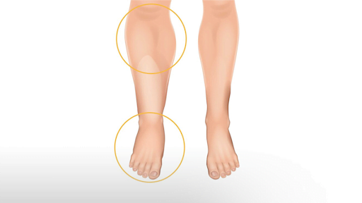 Lymphedema