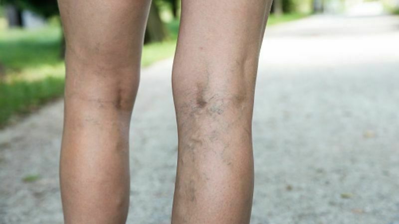 varicose veins in legs
