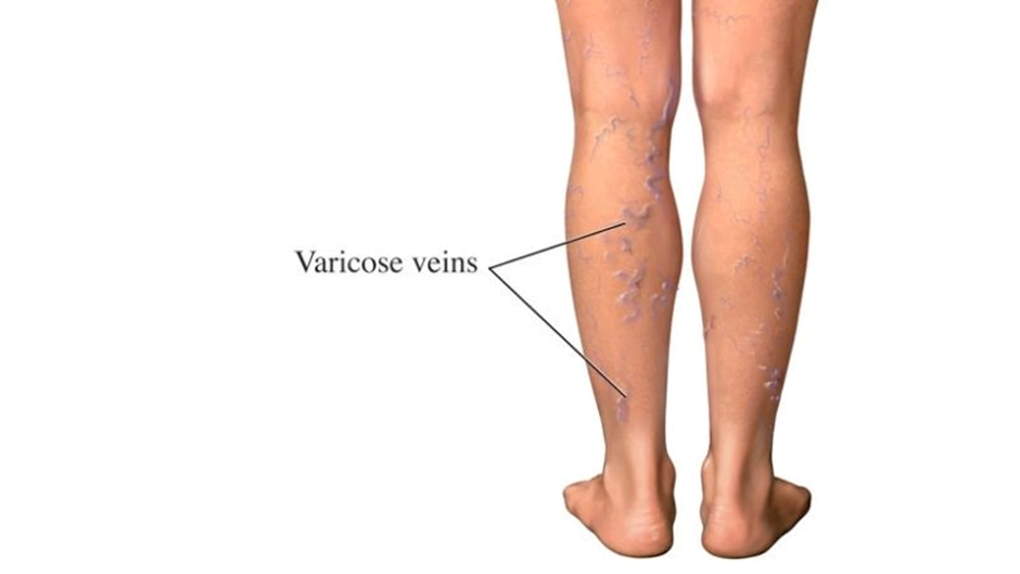 varicose veins