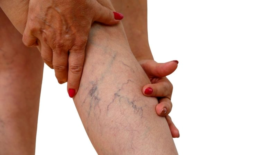 Reasons for Varicose Veins You Need To Be Aware Of