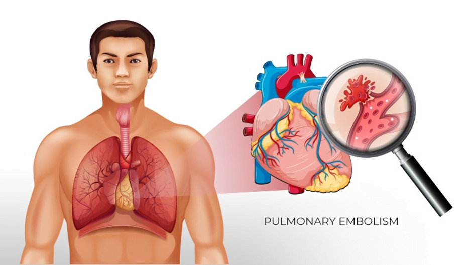 pulmonary embolism