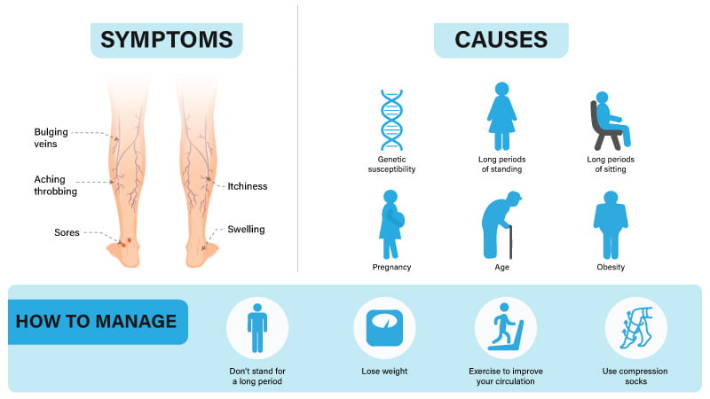 causes of varicose veins