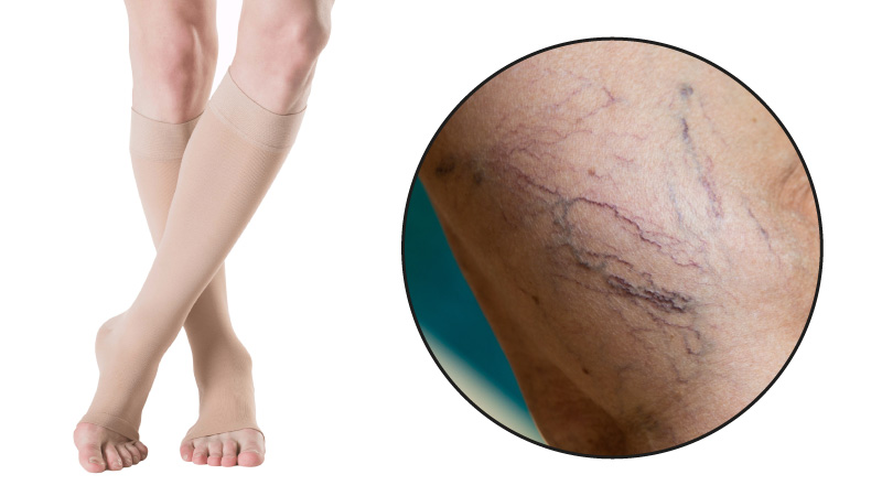 Remedies For Varicose Veins