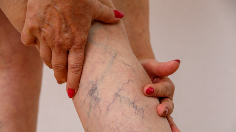 treatment for varicose veins