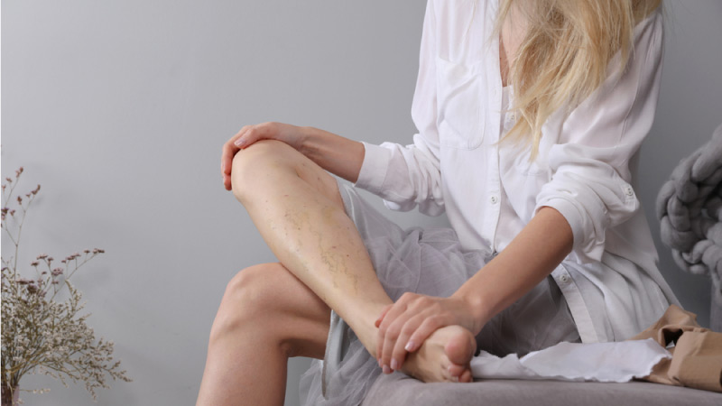 varicose veins home remedies